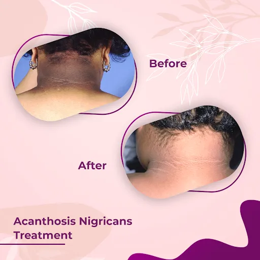 acanthosis nigricans treatment near me