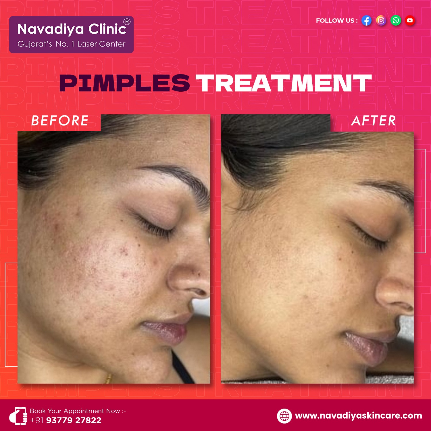 Best Acne Treatment