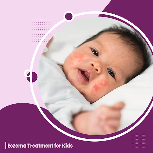 eczema treatment for kids