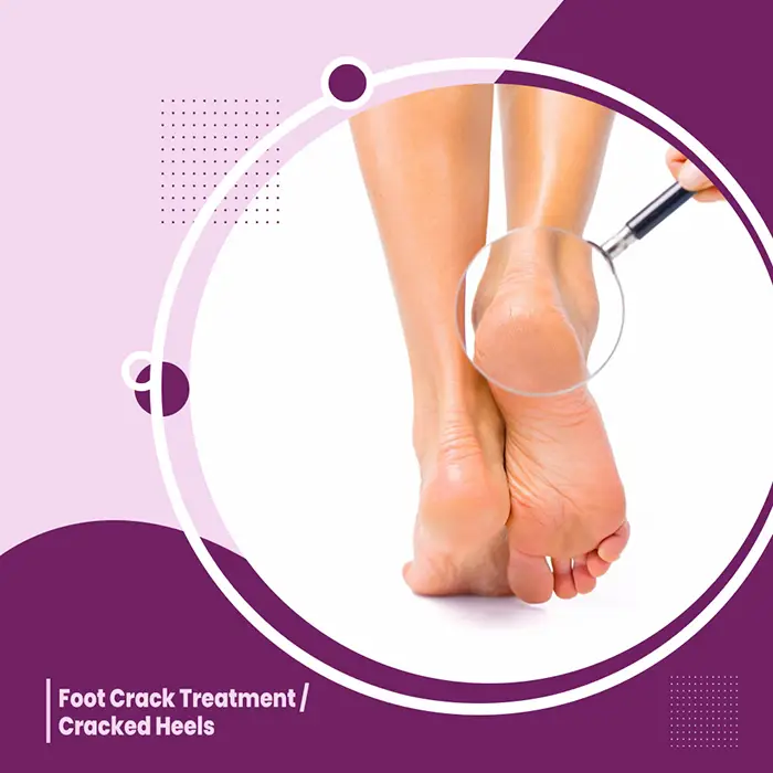 Foot Cracked Treatment in Surat