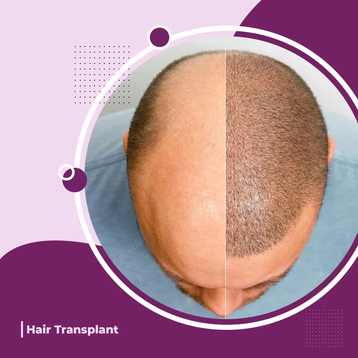 Hair Transplants and Treatment near me