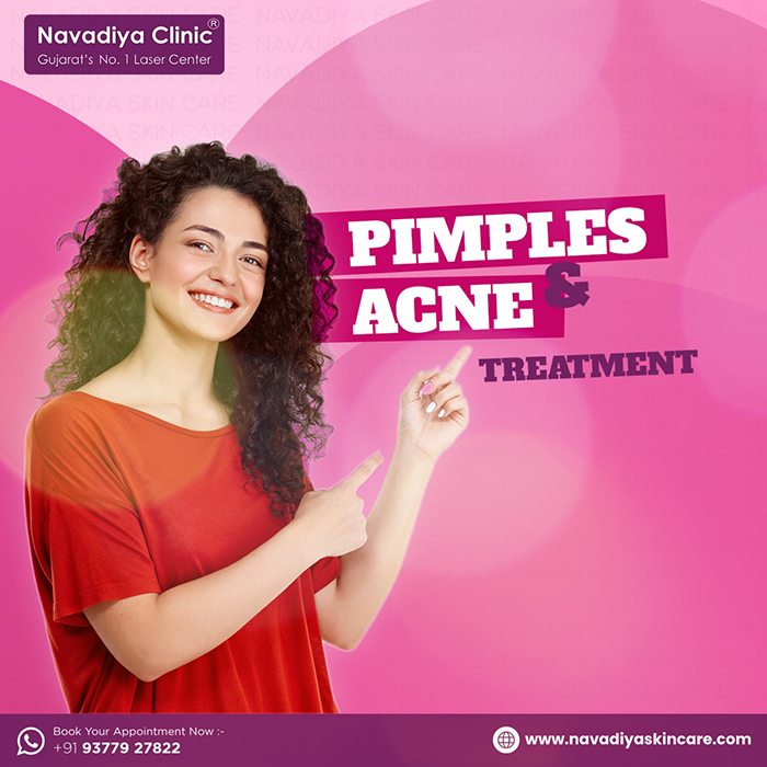 Pimple Removal Treatment