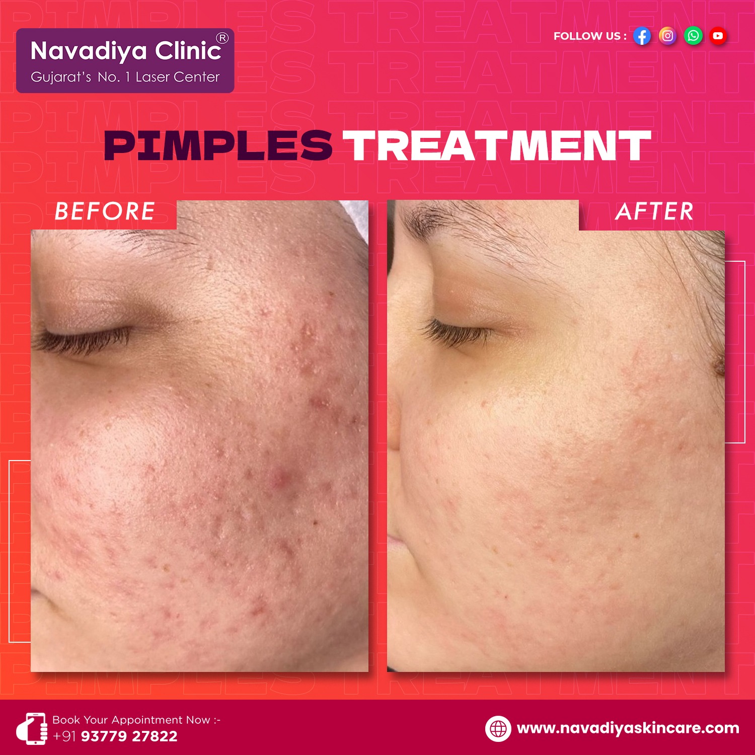 best treatments for acne scars
