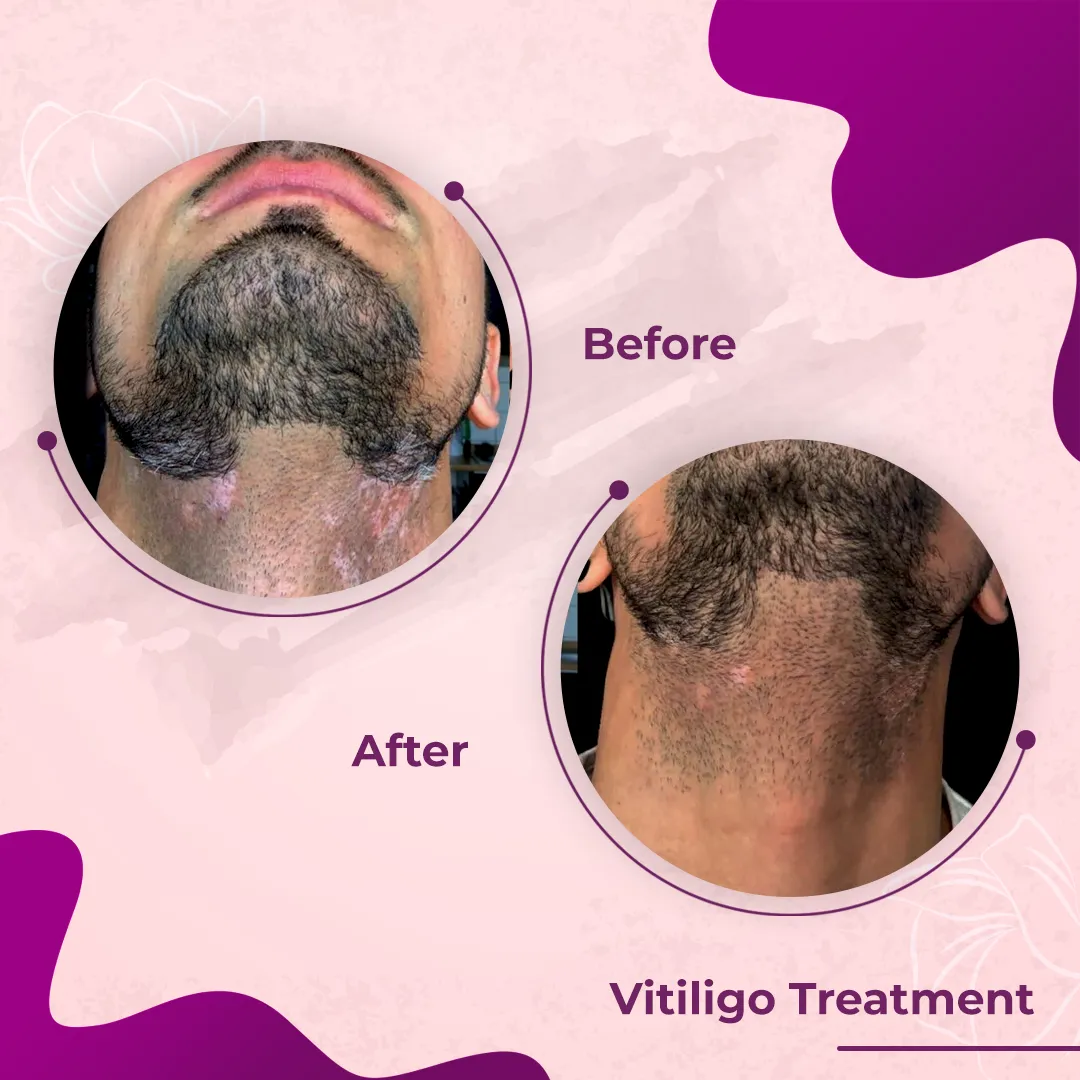 vitiligo treatment near me