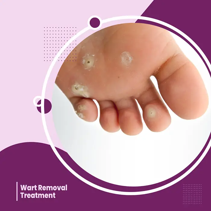 Wart Removal Treatment Near me
